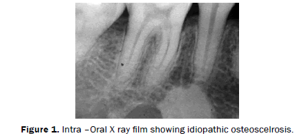 dental-sciences-Panoramic-radiograph-idiopathic-osteoscelrosis