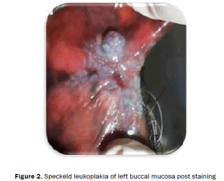 dental-sciences-left-buccal-mucosa